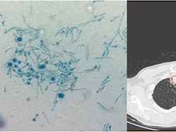 Penampakan Jamur Tanaman Mematikan di Tubuh Pria India, Pertama di Dunia