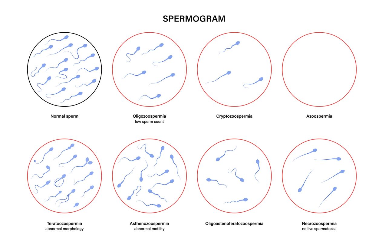 Sperm morphology and ivf research concept. Normal, abnormal and defective human egg. Spermatozoon flat vector illustration. Human sexual reproductive system. Diagram for clinic and education