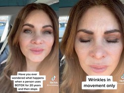 Viral Wanita Setop Botox Setelah 20 Tahun, Perubahan Wajahnya Bikin Salfok