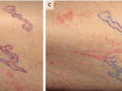 Geli! Ada Banyak Cacing Merayap di Bawah Kulit Pria Ini