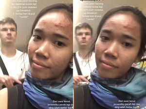 Viral Wanita RI Tak PD Berjerawat, Ditaksir Pria Jerman yang Terima Apa Adanya Viral Wanita RI Tak PD Berjerawat, Ditaksir Pria Jerman yang Terima Apa Adanya