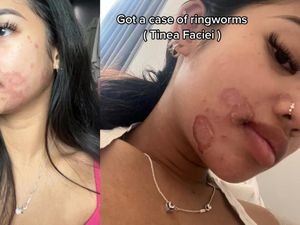 Viral Wajah Wanita Kena Ringworm gegara Berbagi Alat Make-up dengan Teman Viral Wajah Wanita Kena Ringworm gegara Berbagi Alat Make-up dengan Teman