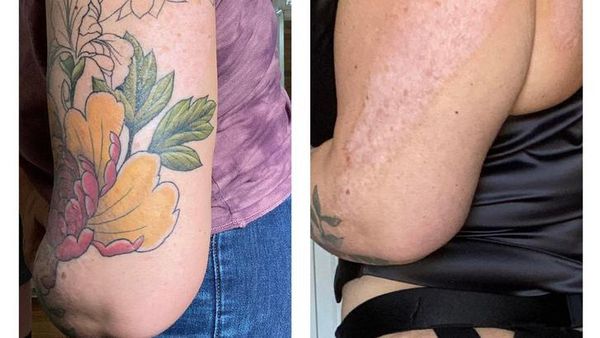 Potret Seni Tato Tutupi Bekas Luka Menjadi Artistik