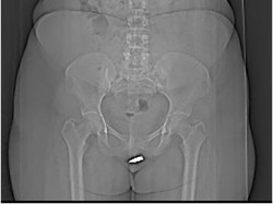 Bikin Ngilu, Begini Penampakan Peluru Nyasar Nyangkut di Klitoris Wanita