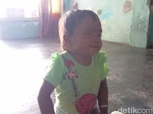 Pengorbanan Ortu di Jember untuk Balita yang Kehilangan Mata Karena Kanker Pengorbanan Ortu di Jember untuk Balita yang Kehilangan Mata Karena Kanker