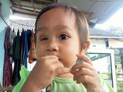 Derita Balita di Jember Kehilangan Bola Mata Akibat Kanker