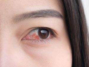 6 Cara Mengatasi Mata Merah dan Kenali Penyebabnya, Jangan Panik! 6 Cara Mengatasi Mata Merah dan Kenali Penyebabnya, Jangan Panik!