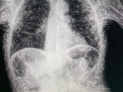 Hii... Dokter Temukan Ratusan Parasit Cacing Pita Bersarang di Tubuh Pasien