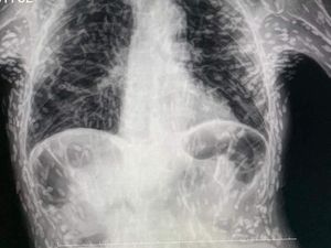 Hii... Dokter Temukan Ratusan Parasit Cacing Pita Bersarang di Tubuh Pasien Hii... Dokter Temukan Ratusan Parasit Cacing Pita Bersarang di Tubuh Pasien