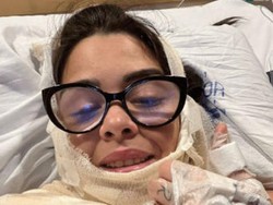 Kondisi DJ Wanita yang Kena Luka Bakar karena Panci Meledak, Butuh 21 Operasi