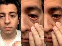 Kronologi Pria yang Matanya Berubah Aneh gegara Tertular COVID-19 Varian Arcturus