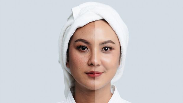 Ilustrasi Melasma