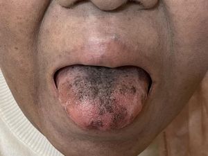 Fakta-fakta BHT, Kondisi Langka yang Bikin Lidah Hitam dan Berbulu Fakta-fakta BHT, Kondisi Langka yang Bikin Lidah Hitam dan Berbulu