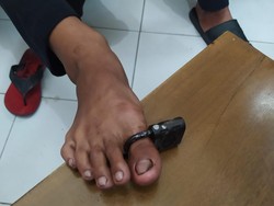Ada-ada Saja, Damkar Klaten Dimintai Tolong Lepas Gembok di Jempol Kaki Remaja