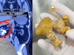 Viral Wanita Punya Batu Ginjal Sebesar Jahe, Ternyata Ini Pemicunya