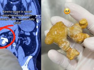 Viral Wanita Punya Batu Ginjal Sebesar Jahe, Ternyata Ini Pemicunya Viral Wanita Punya Batu Ginjal Sebesar Jahe, Ternyata Ini Pemicunya