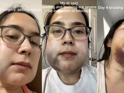 Viral Kisah Wanita Cabut Gigi Bungsu, Berujung Rahang Bengkak dan Memar