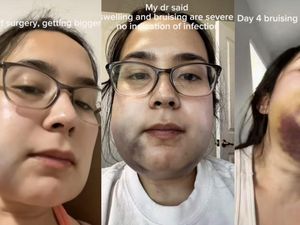 Viral Kisah Wanita Cabut Gigi Bungsu, Berujung Rahang Bengkak dan Memar Viral Kisah Wanita Cabut Gigi Bungsu, Berujung Rahang Bengkak dan Memar