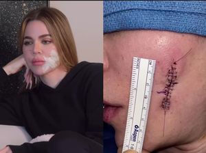 Khloe Kardashian Buka-bukaan Kondisi Terbarunya Pasca Operasi Kanker Kulit