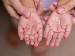 Anak-anak Korban Bencana Sumatera Dihantui Risiko Campak Imbas Imunisasi Rendah