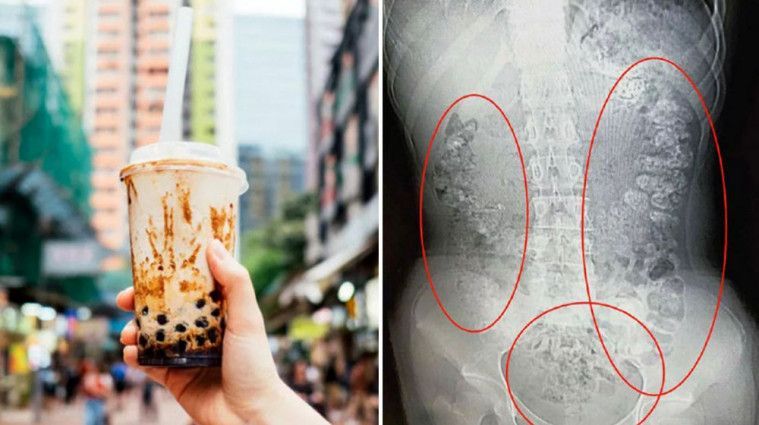 5 Orang Ini Hobi Minum Bubble Tea Berlebihan, Ada yang Koma hingga Lumpuh