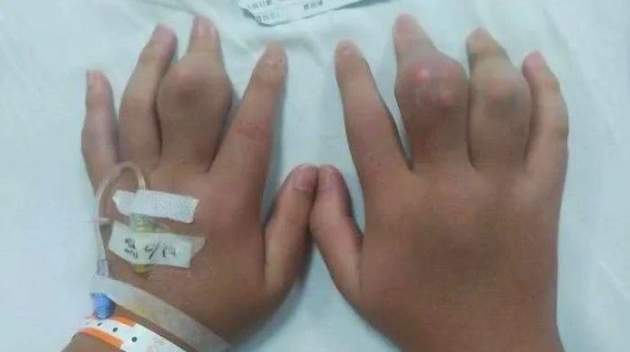 5 Orang Ini Hobi Minum Bubble Tea Berlebihan, Ada yang Koma hingga Lumpuh