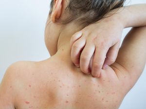 13 Penyebab Bintik Merah pada Kulit, Kapan Harus ke Dokter? 13 Penyebab Bintik Merah pada Kulit, Kapan Harus ke Dokter?