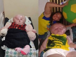 Kepala Wanita 29 Tahun Ini Membesar 3 Kali Lipat, Tak Bisa Bergerak dan Melihat