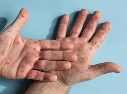 AS Laporkan Kematian Akibat Wabah Campak, Pertama dalam 10 Tahun Terakhir