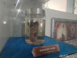 37 Jenis Kanker dan Cara Mengobatinya Menurut dr Ananto