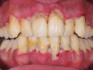 10 Cara Menghilangkan Karang Gigi Secara Alami dan Cepat