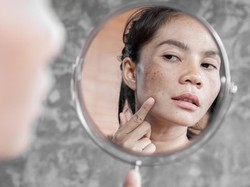 Sering Dikira Bercak Biasa, Ini Cara Bedakan Flek Hitam VS Gejala Kanker Kulit