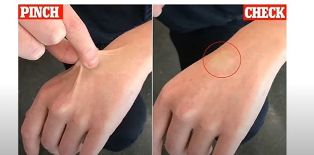 kulit kurang elastis