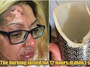 Apes! Wajah Wanita Ini Terbakar Usai Coba Resep Telur Viral di TikTok