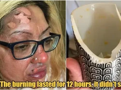 Apes! Wajah Wanita Ini Terbakar Usai Coba Resep Telur Viral di TikTok