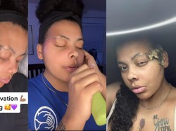 Viral Wanita Idap Penyakit Langka Berawal dari Tanda Lahir, Ini Gejala Awalnya