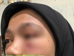 Mahasiswi FT UHO Kendari Dianiaya Senior hingga Wajah Lebam Lapor Polisi