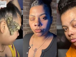 Viral Wanita Kena Kelainan Genetik, Dikira Tanda Lahir Lalu Melebar dan Berbau