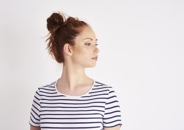 Penyebab dark spot karena melasma / Foto: freepik.com