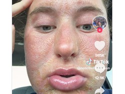 Netizen Berbagi Cerita Tersengat Matahari, Ada yang Sampai Mengelupas Parah