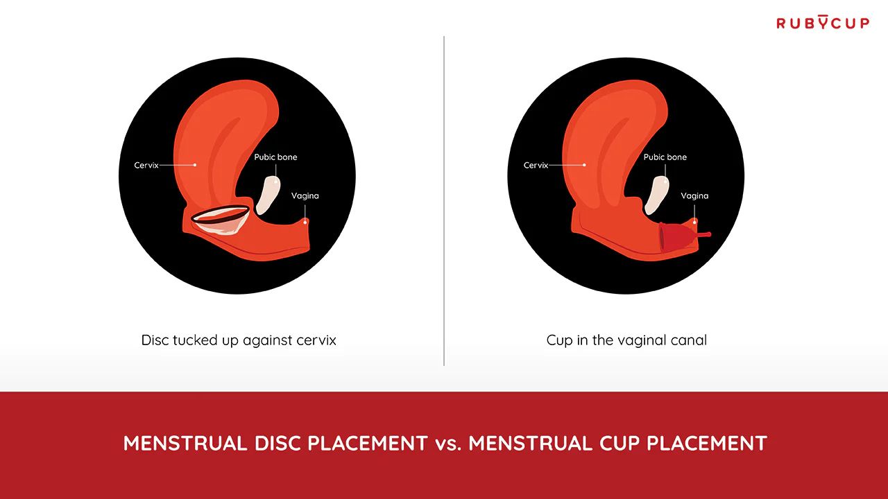 Perbedaan peletakan menstrual cup dan menstrual disc