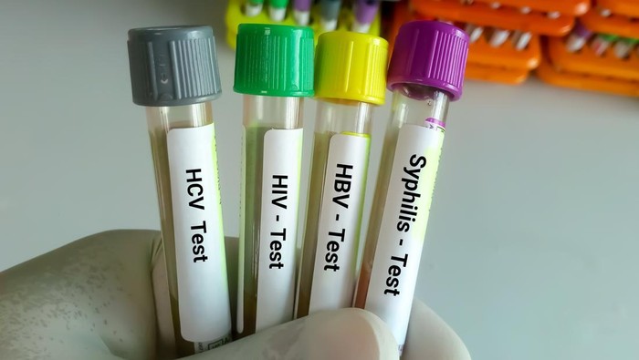 Scientist hold blood samples tube for Sexuallly Transmitted Disease. Syphilis,  HBV, HIV, HCV