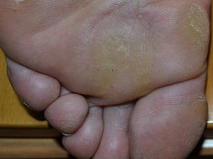 Mata Ikan di Kaki: Definisi, Ciri-ciri, Penyebab, Cara Penanganan Mata Ikan di Kaki: Definisi, Ciri-ciri, Penyebab, Cara Penanganan