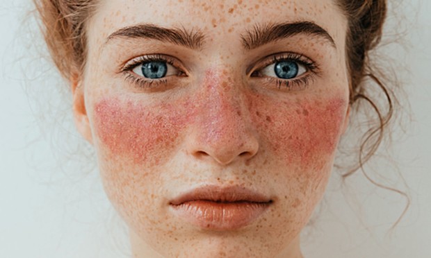 Seseorang dengan Penyakit Lupus, Ditandai adanya Butterfly Rashes di Wajahnya/ Foto: herminahospitals.com