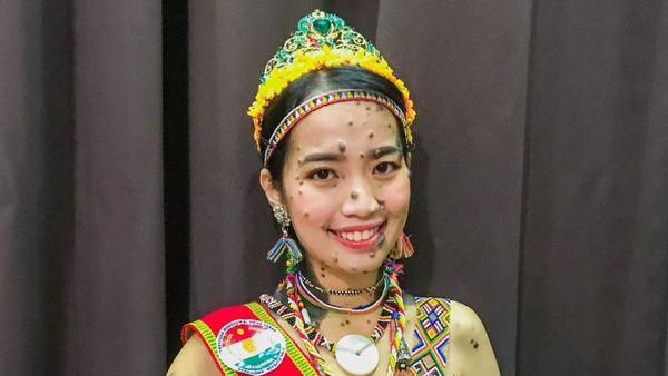 7 Foto Wanita Dulu Viral Wajah dan Tubuh Penuh Tahi Lalat, Nasibnya Kini...