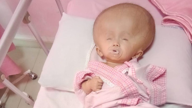 Yuk Kita Bantu Bagas, Penderita Hidosefalus Anak Kuli Panggul Kayu