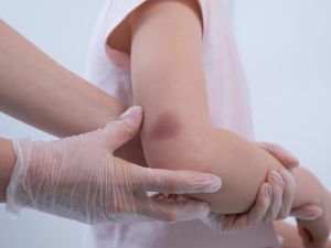 Tiba-tiba Muncul Luka Memar di Kulit, Gegara Dijilat Jin? Begini Faktanya!