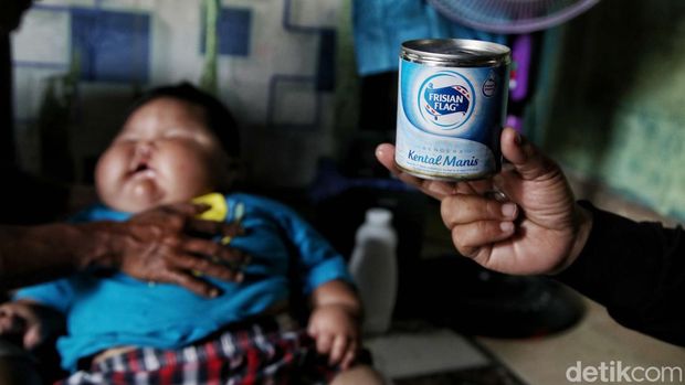 Balita Kenzie mengalami obesitas, berat badannya mencapai 27 kg di usia satu tahun