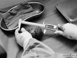 Dokter Angkat Batu Ginjal Terbesar di Dunia, Bobotnya 801 Gram