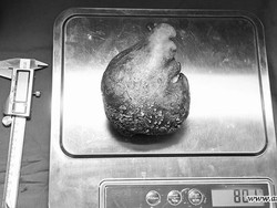 Dokter Angkat Batu Ginjal Terbesar dan Terberat di Dunia, Bobotnya 801 Gram